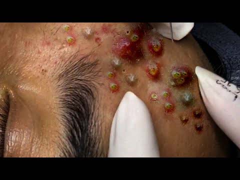 Top 10 New BlackHead #6