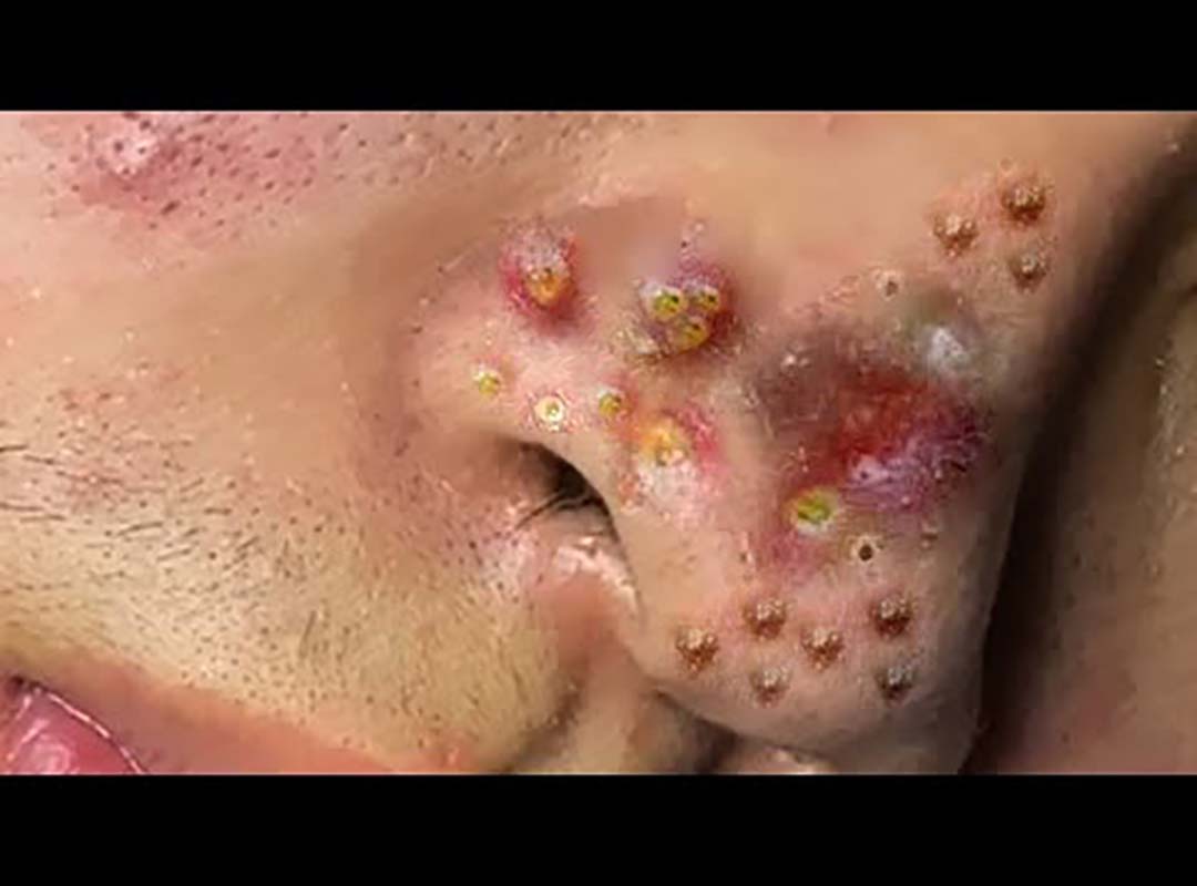 Top 10 New BlackHead #7